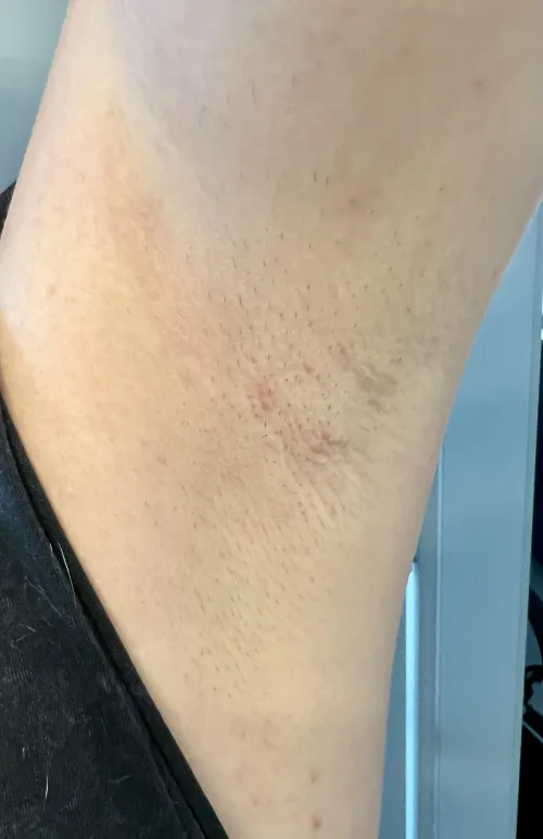 Thumbnail Embracing Natural Beauty: Dealing with Underarm Hair | sunnypits
