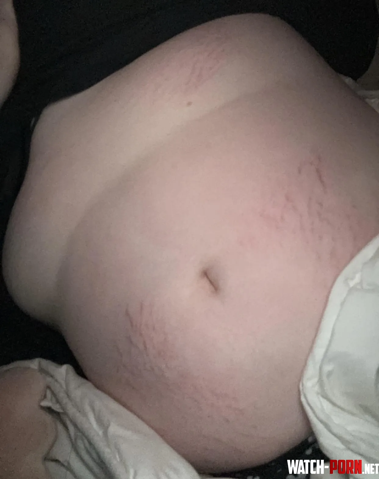 dont think im ever escaping the stretch marks by st0nedcut1e