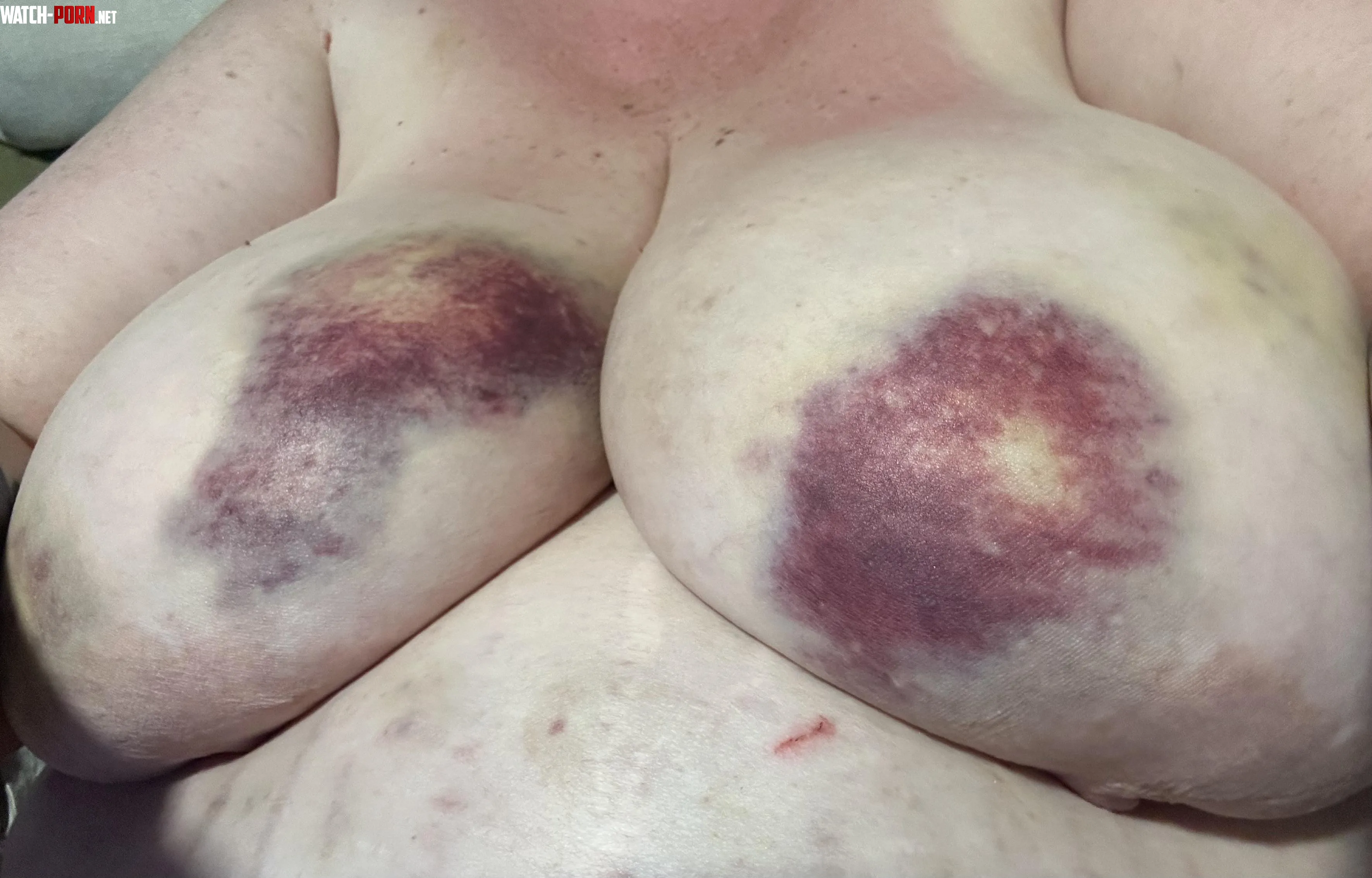 Bruises look amazing by Puddlypooh1969