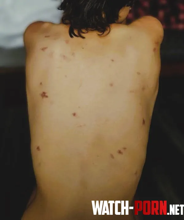 NB I love how my back looks after a meetup  by vodkudzu