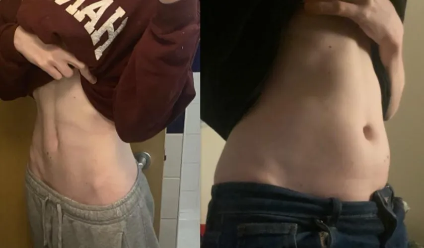 Thumbnail Worldly-Respect2668's Transformation: 'I'm Still Fashion Model Skinny Right' in wgbeforeafter