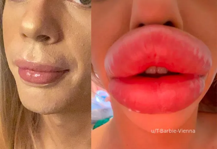 Thumbnail Pout Perfection: My Lips 2020 v 2025 Can't Wait - Let's Get Bigger! by T-Barbie-Vienna