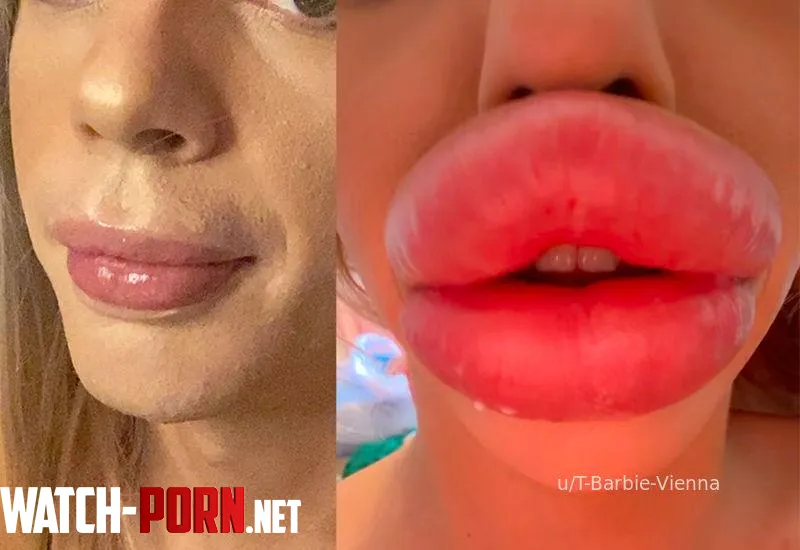 My Lips 2020 v 2025 cant wait getting them even bigger Vienna Xtreme by T-Barbie-Vienna