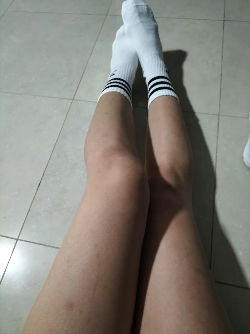 Thumbnail Yums153's Scars Story: A Journey of Resilient Legs