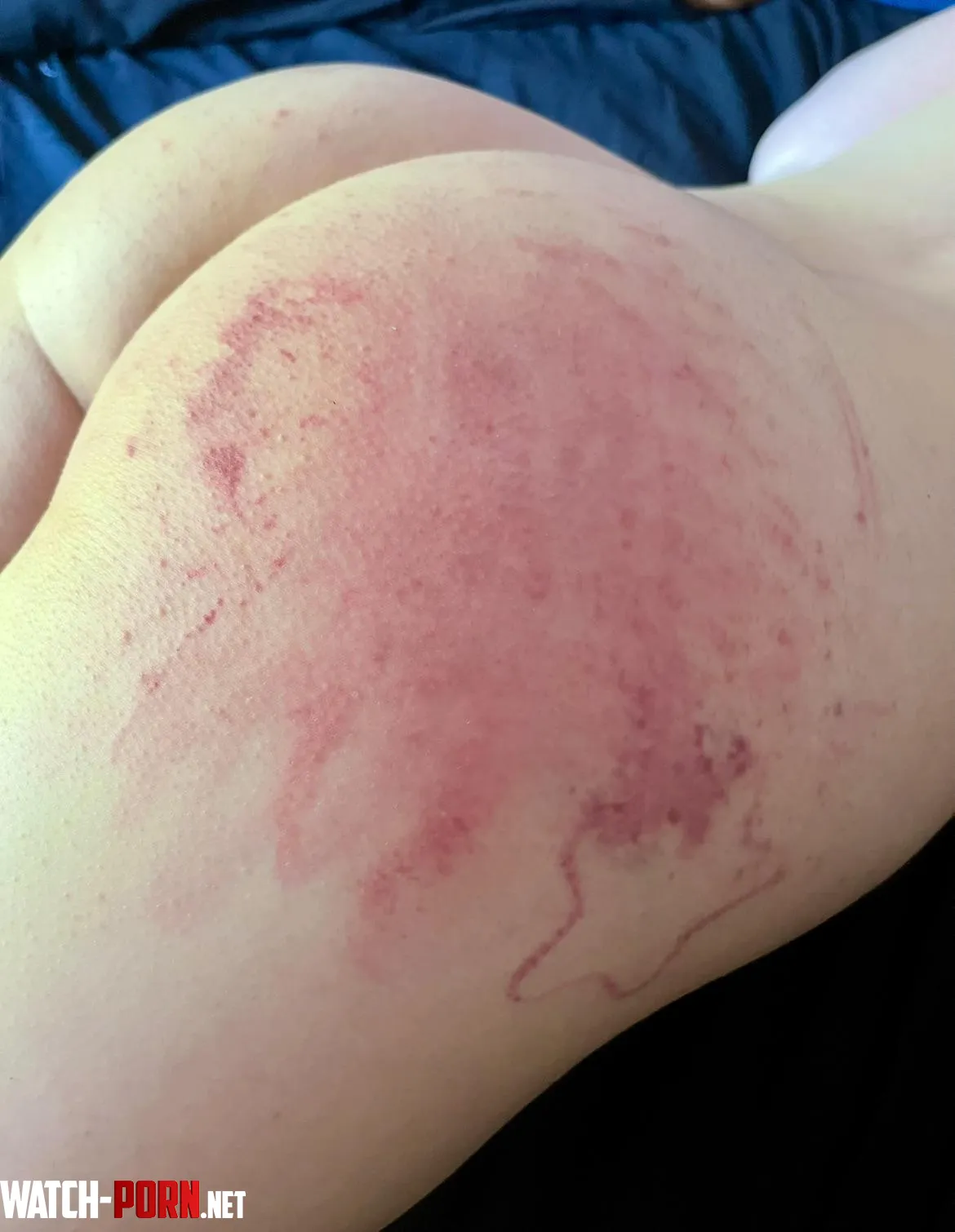 [F] She worked very hard to earn these bruises by rundaround
