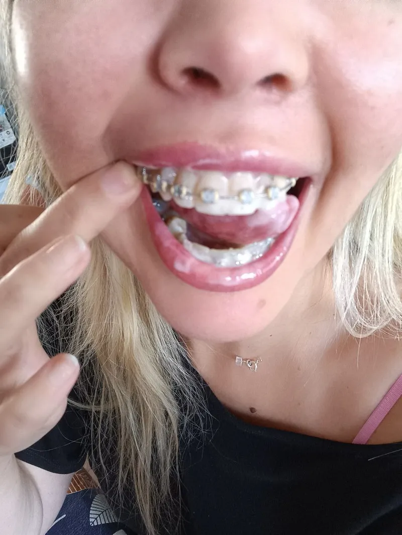 Thumbnail Tantalizing Tale: 'Covered My Braces with His Delicious Cum' in CumFetish