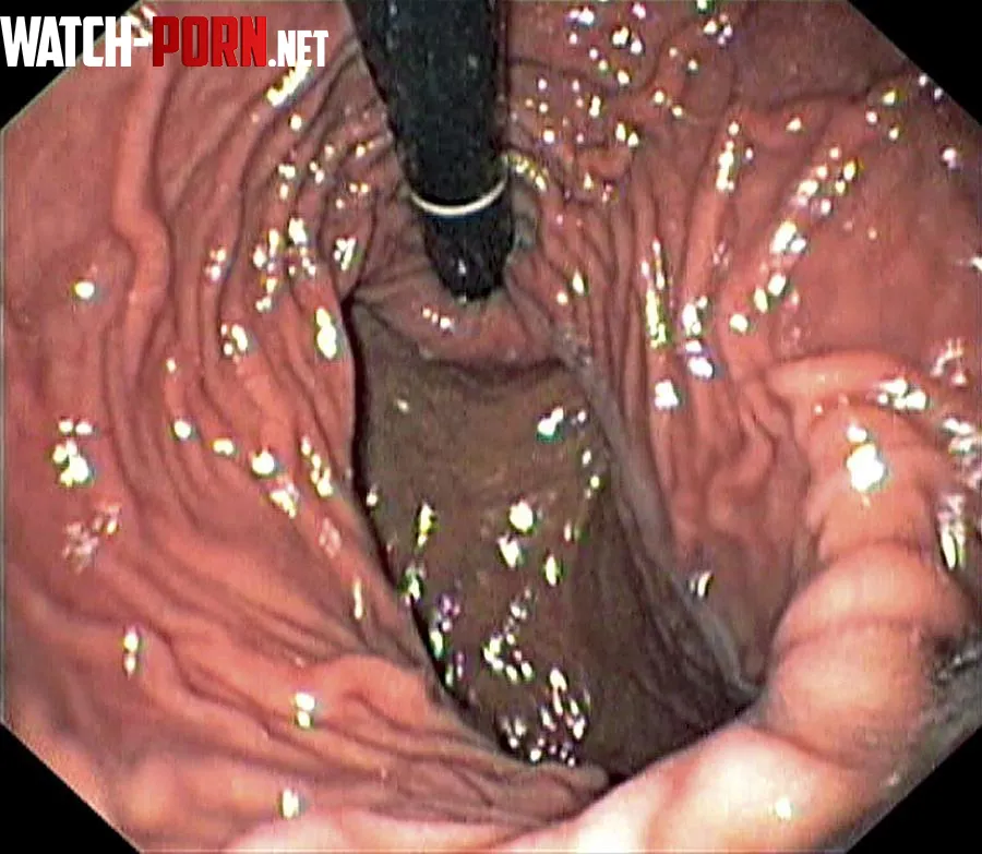 {image} saw this online. It’s what an actual human stomach looks like. (Source: https://sciencephotogallery.com/featured/3-healthy-stomach-gastrolab.html) by Substantial_Slip4667