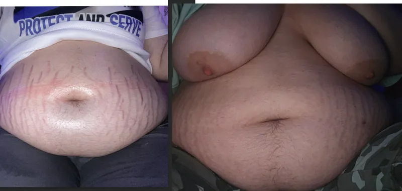 Thumbnail Fading Stretch Marks: Embracing Changes by Beautiful-Kiwi-4278