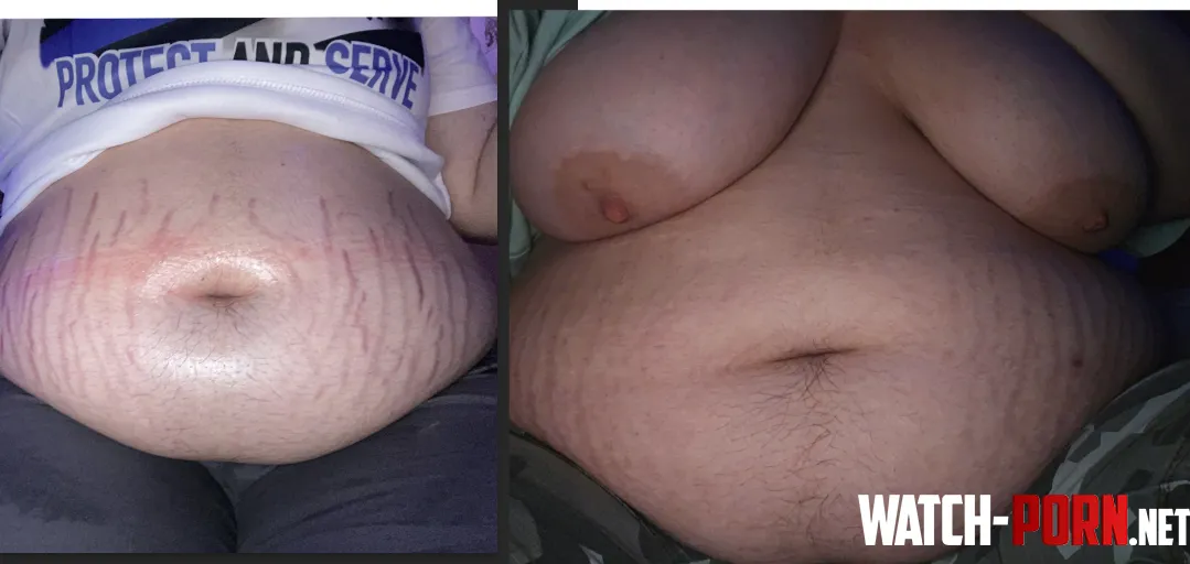 Stretch marks faded by Beautiful-Kiwi-4278