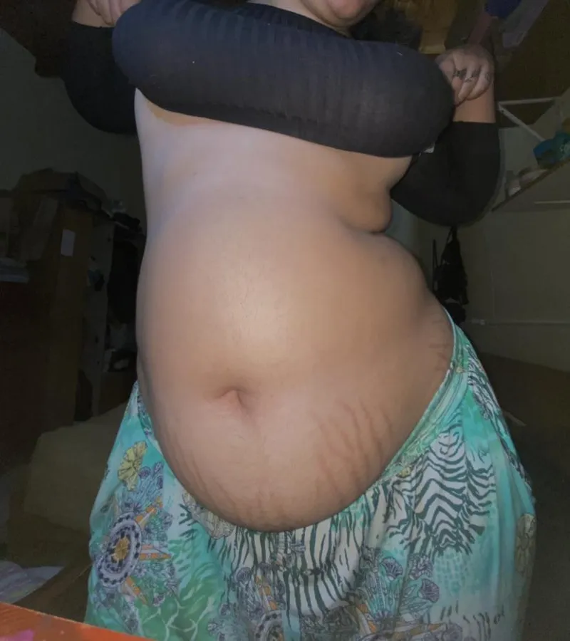 Thumbnail Lumpaschubby: Huge Stretch Marks Reveal - WGBeforeAfter