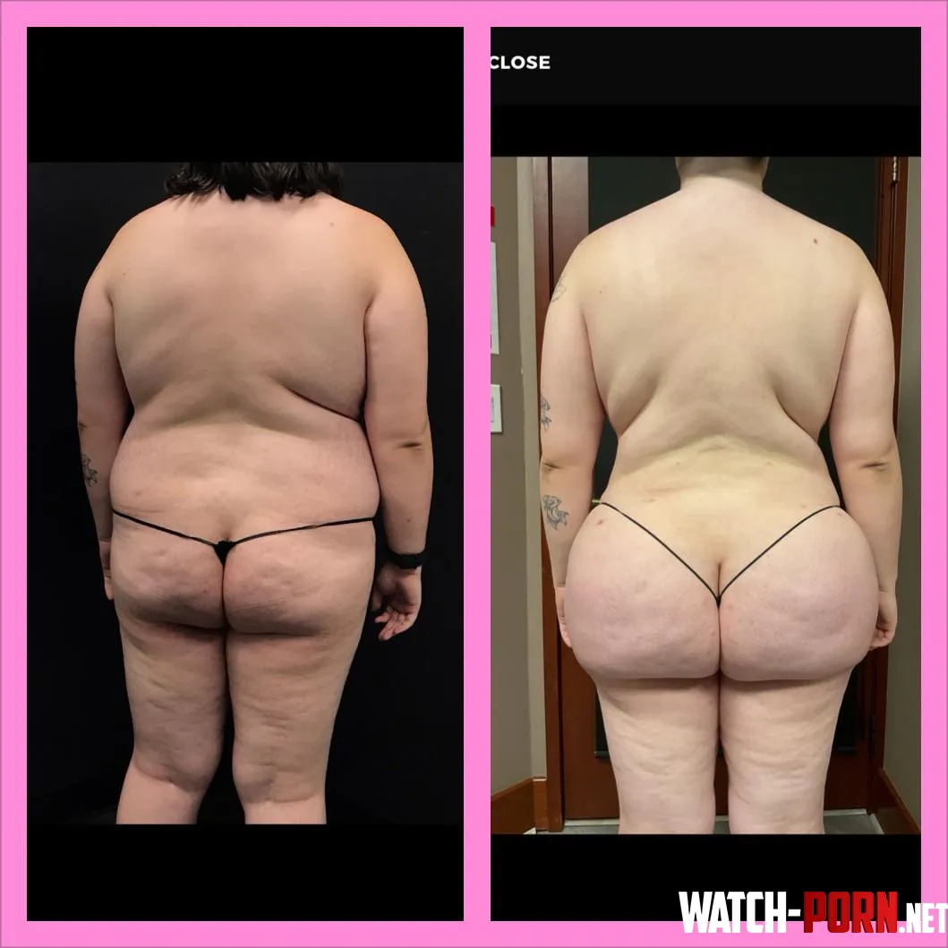 1 year Later, 3 BBL’s…. Butt+Hip implants next 😈 by Lulu_pa_sodo