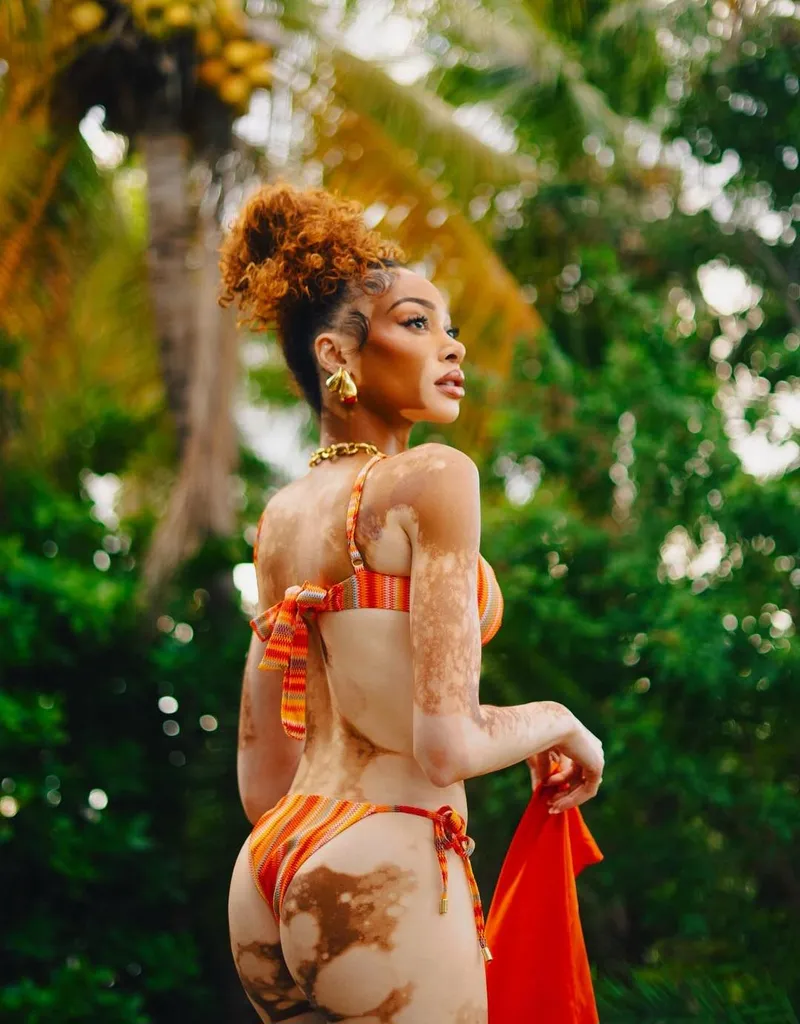 Thumbnail Winnie Harlow: Redefining Beauty Standards by Onehornymofo1