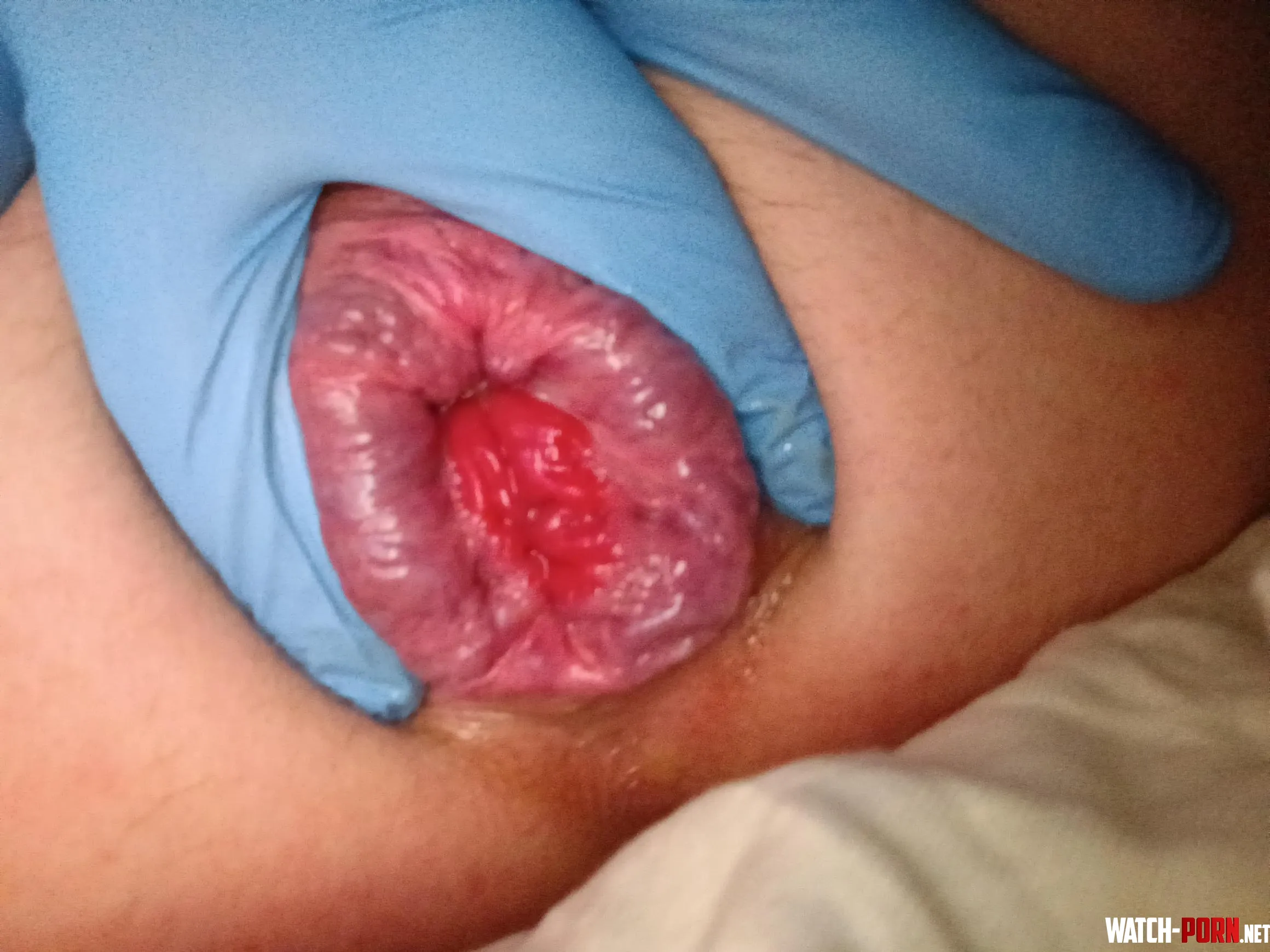 Results of being on my period he only used my asshole for the last 6 days by PerfectPeaches907