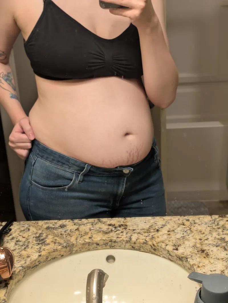 Thumbnail Stretchmarks coming in