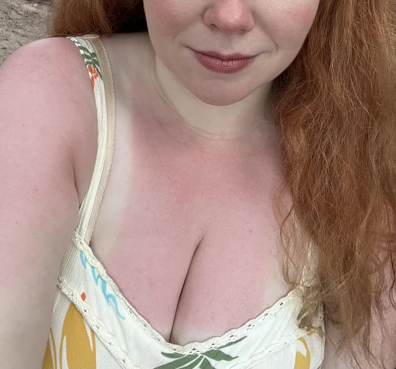 Thumbnail In true pale girl fashion, I got sunburnt on a cloudy, rainy day