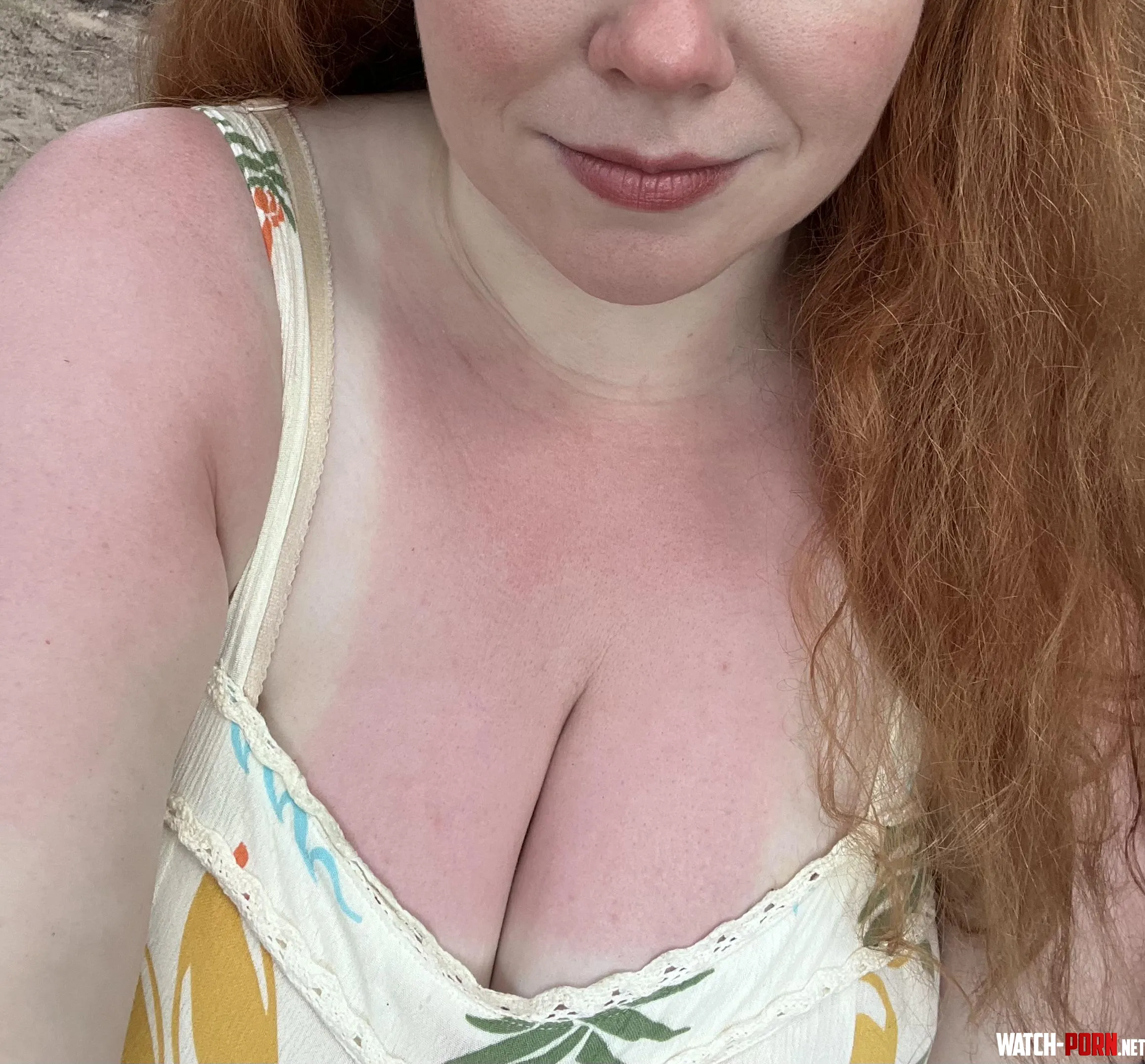 In true pale girl fashion, I got sunburnt on a cloudy, rainy day by chickie1461